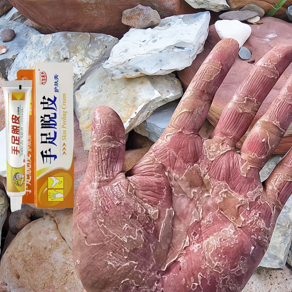 手气手痒手脱皮起小水泡脱皮手心痒手指缝痒手烂手霜抑菌软膏裂膏