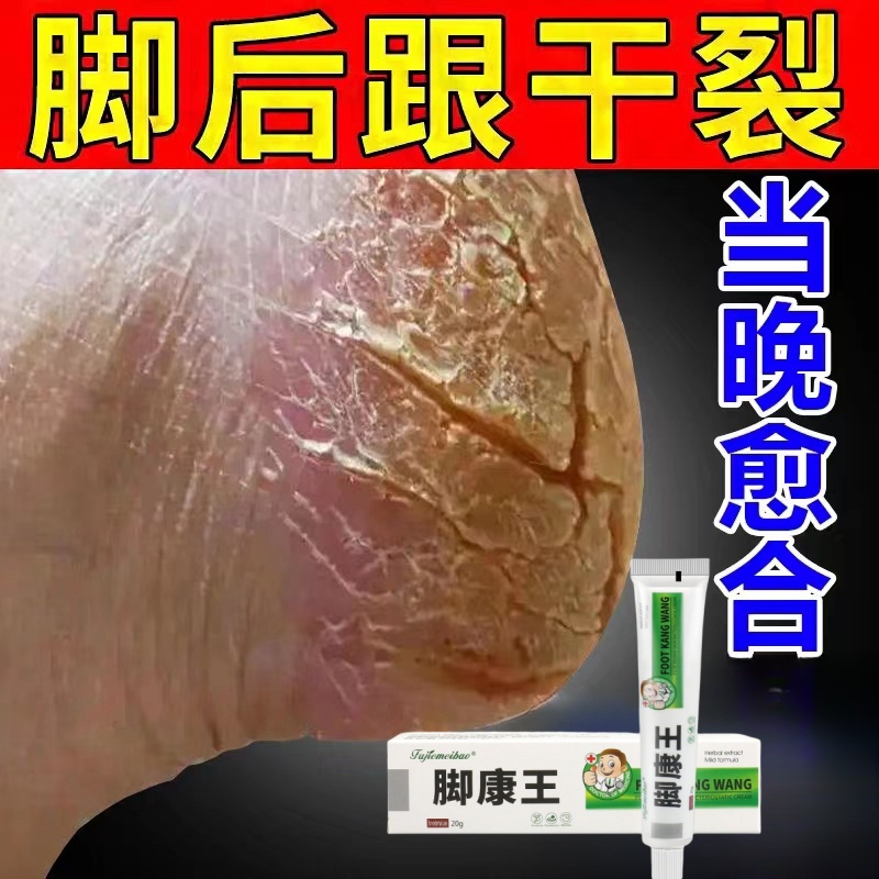 手裂的软膏防干裂手脚脱皮开裂脚后跟干裂脚裂防裂脚康王抑菌软膏